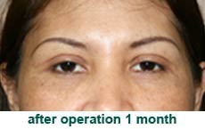 plastic-surgery-blepharoplasty